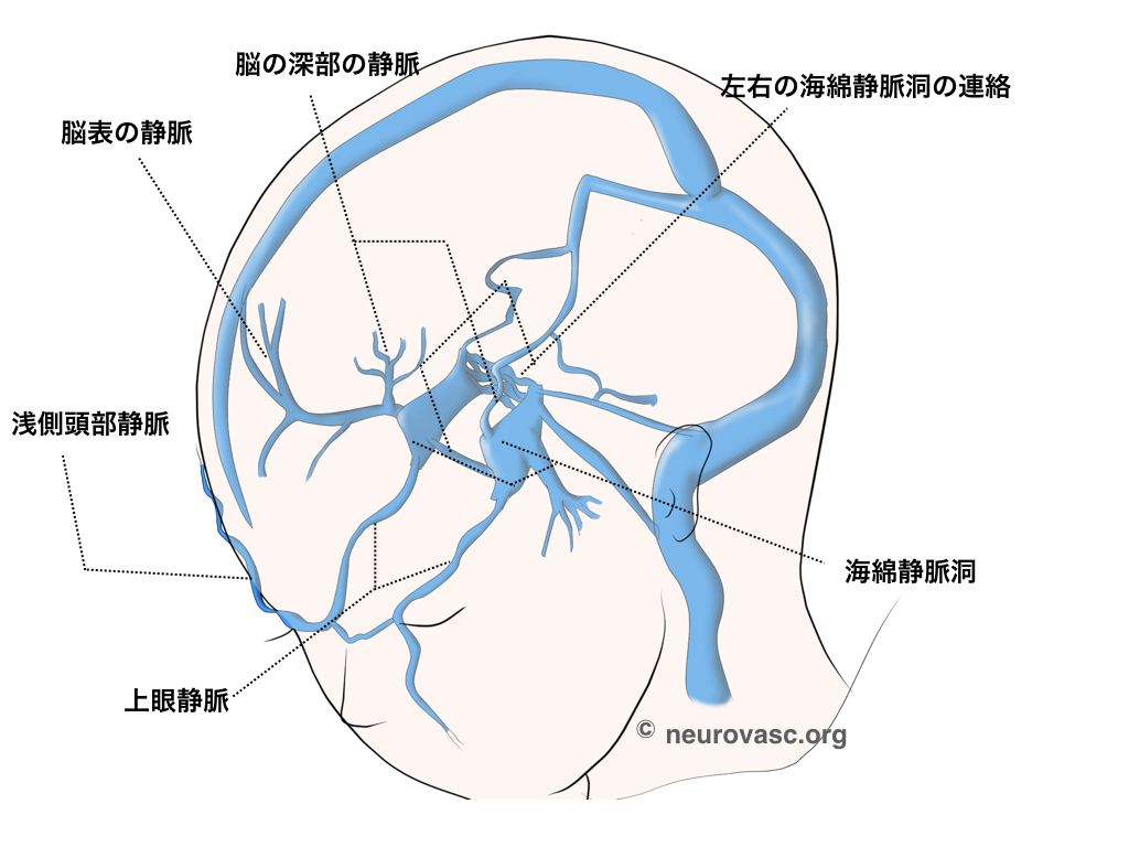 海綿静脈洞部硬膜動静脈瘻 – 脳血管障害
